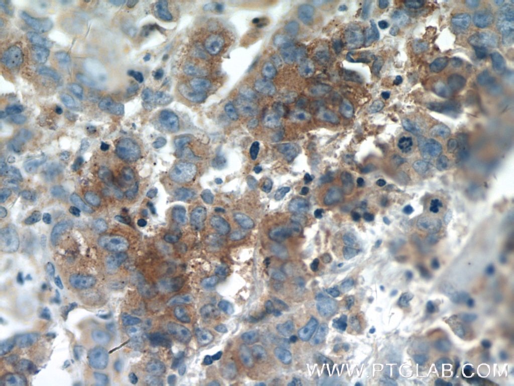 IHC staining of human prostate cancer using 60059-1-Ig