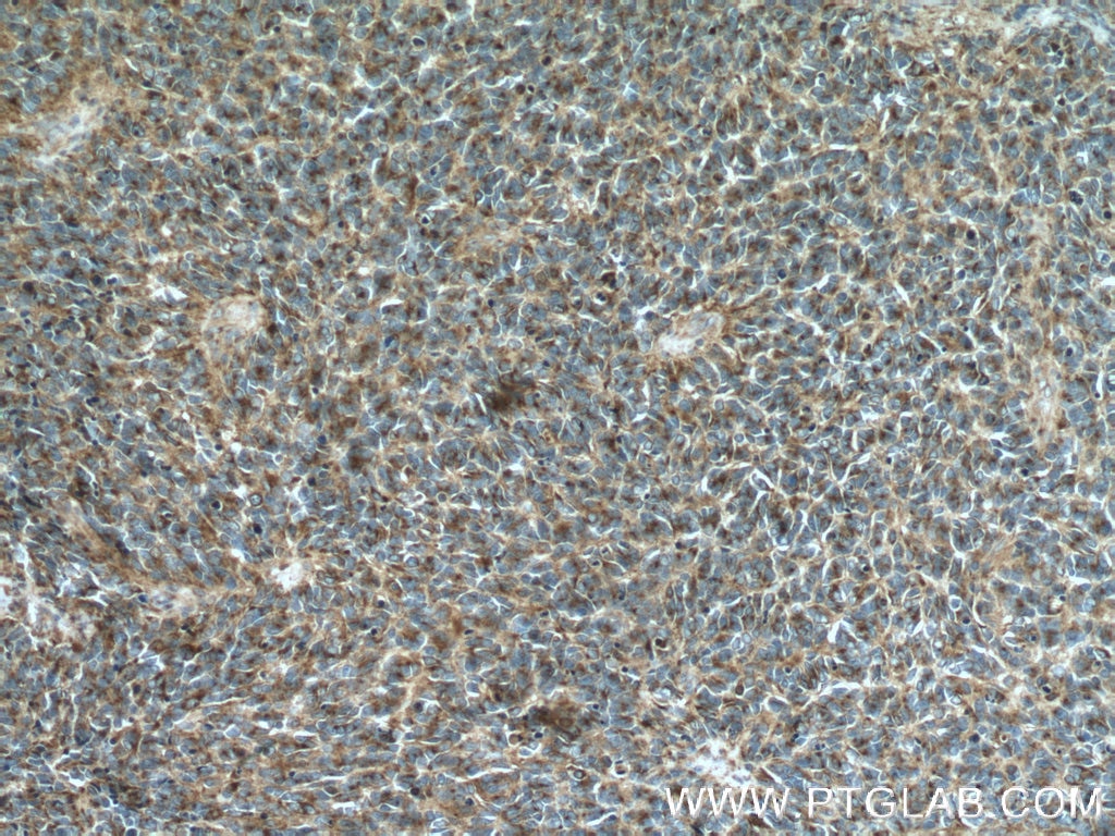 Immunohistochemistry (IHC) staining of human medulloblastoma tissue using Syntaxin 7 Polyclonal antibody (12322-1-AP)