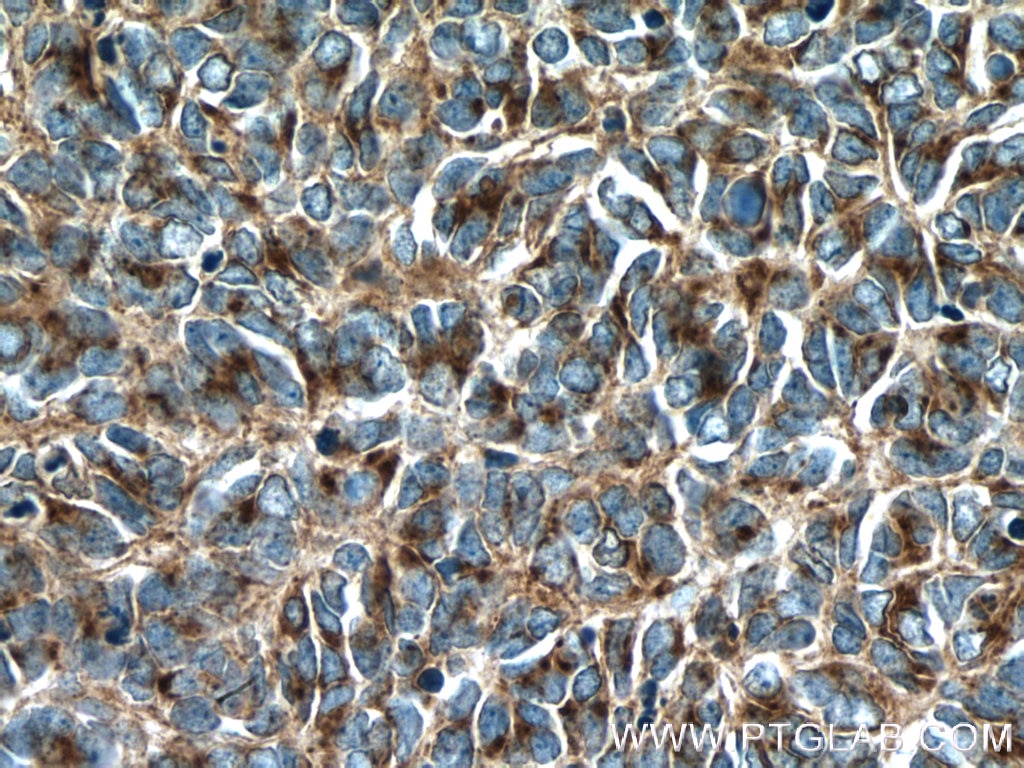 Immunohistochemistry (IHC) staining of human medulloblastoma tissue using Syntaxin 7 Polyclonal antibody (12322-1-AP)