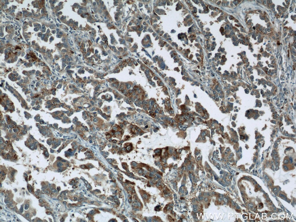 Immunohistochemistry (IHC) staining of human lung cancer tissue using STXBP2 Polyclonal antibody (15312-1-AP)