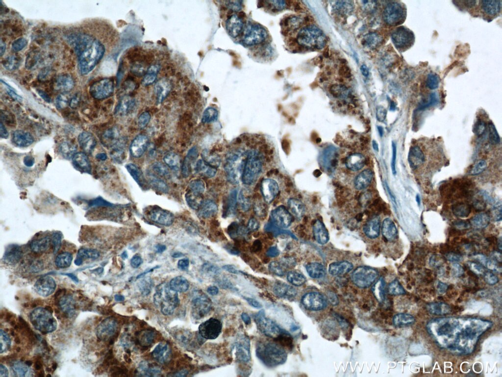 Immunohistochemistry (IHC) staining of human lung cancer tissue using STXBP2 Polyclonal antibody (15312-1-AP)