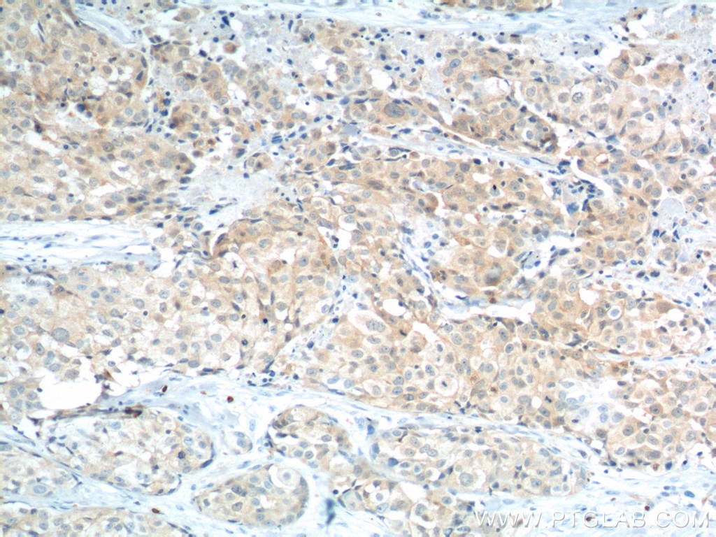 Immunohistochemistry (IHC) staining of human lung cancer tissue using STXBP2 Monoclonal antibody (66238-1-Ig)