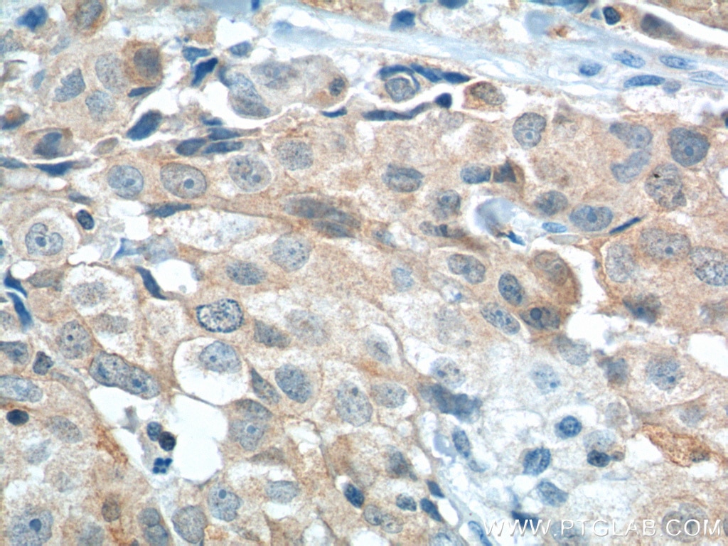Immunohistochemistry (IHC) staining of human lung cancer tissue using STXBP2 Monoclonal antibody (66238-1-Ig)