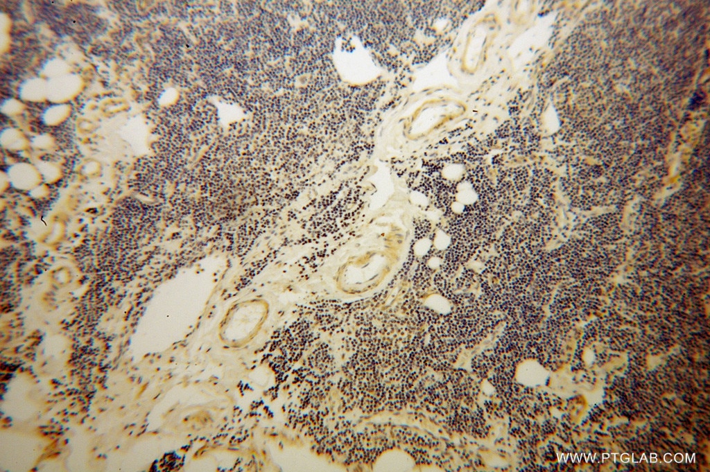 Immunohistochemistry (IHC) staining of human lymphoma tissue using STXBP3 Polyclonal antibody (13764-1-AP)