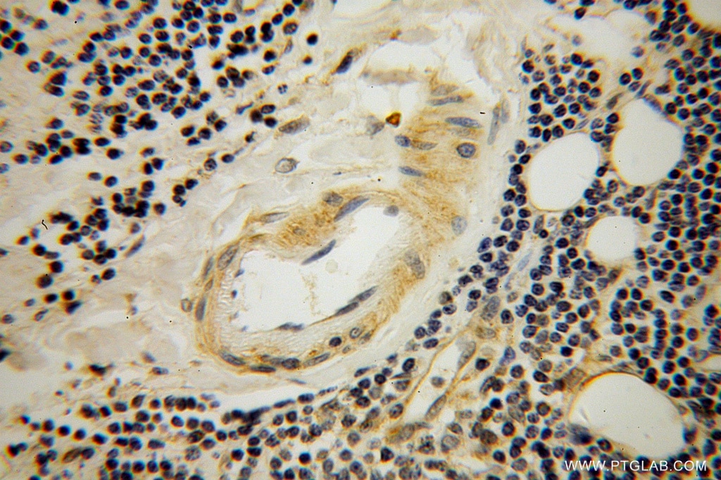 Immunohistochemistry (IHC) staining of human lymphoma tissue using STXBP3 Polyclonal antibody (13764-1-AP)