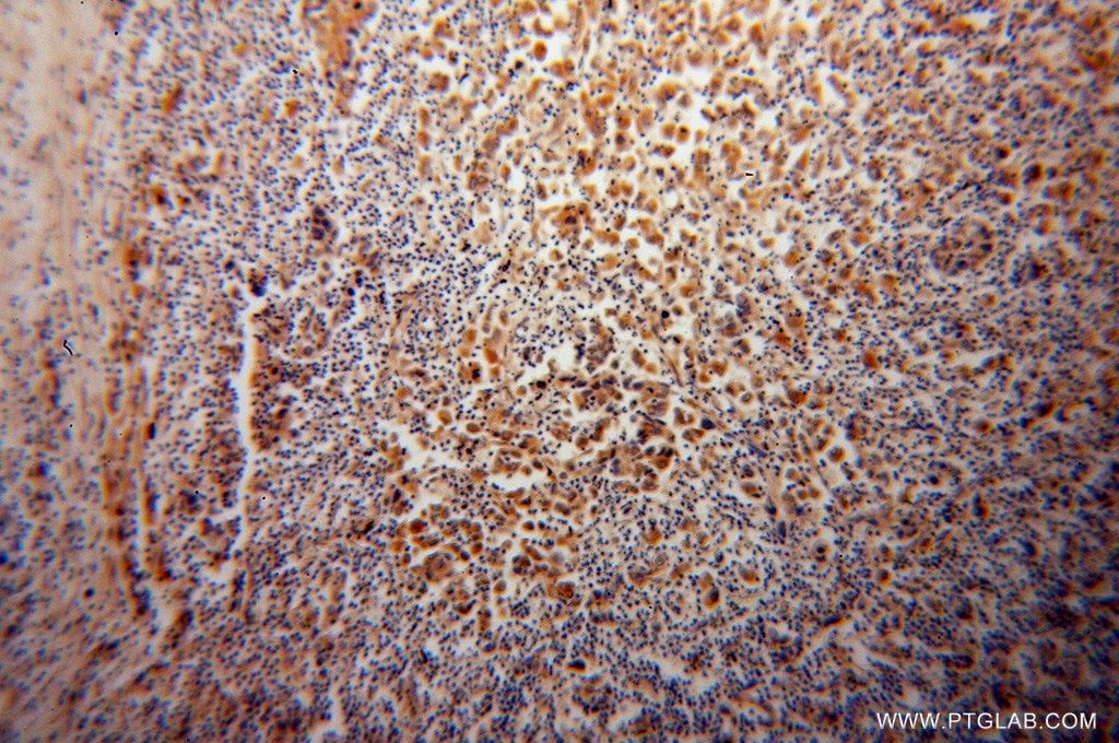 IHC staining of human pancreas cancer using 14231-1-AP