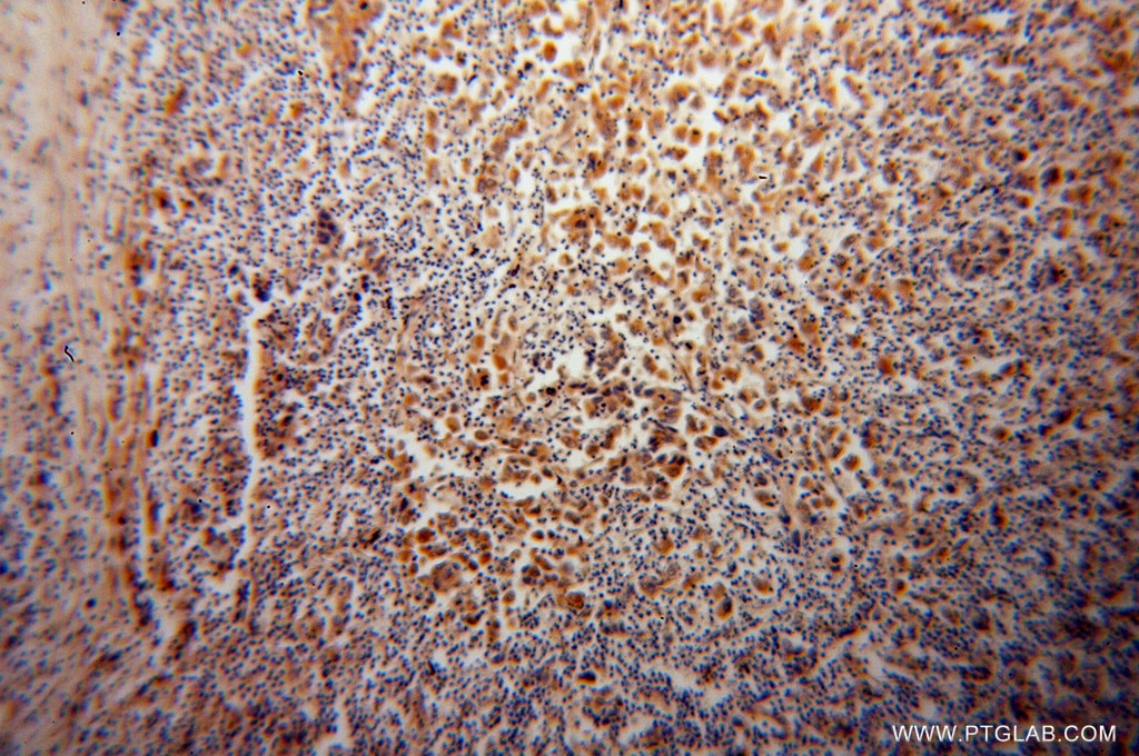 Immunohistochemistry (IHC) staining of human pancreas cancer tissue using STXBP4 Polyclonal antibody (14231-1-AP)