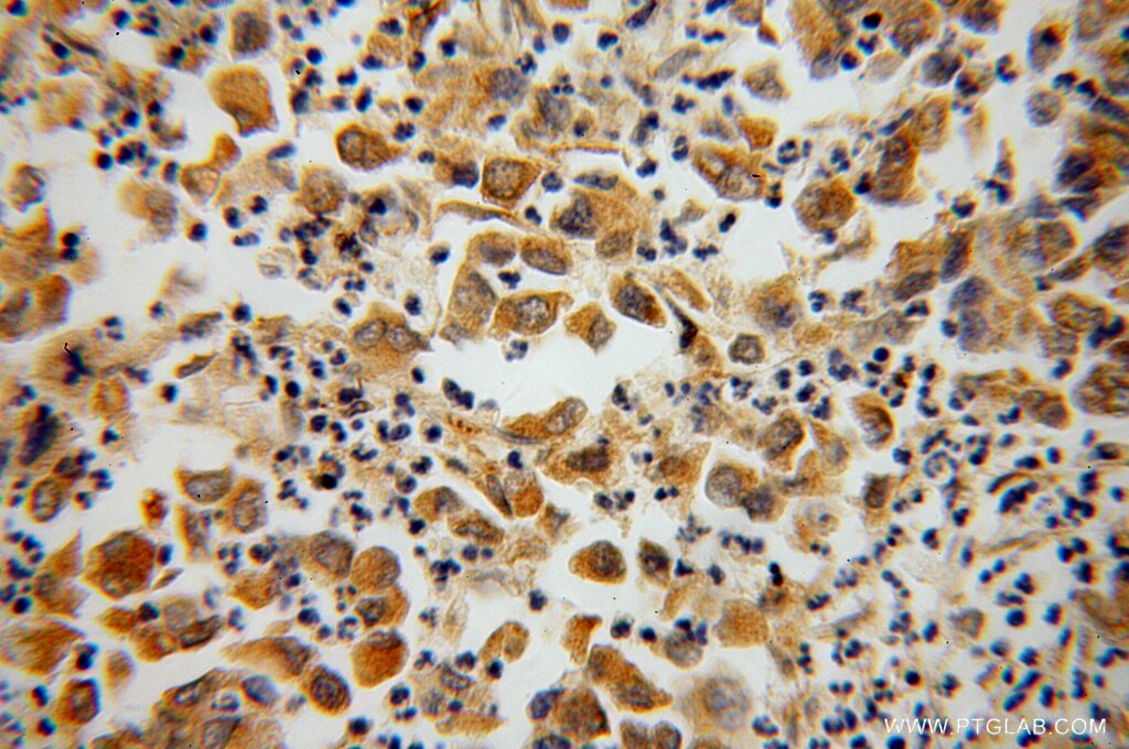 Immunohistochemistry (IHC) staining of human pancreas cancer tissue using STXBP4 Polyclonal antibody (14231-1-AP)