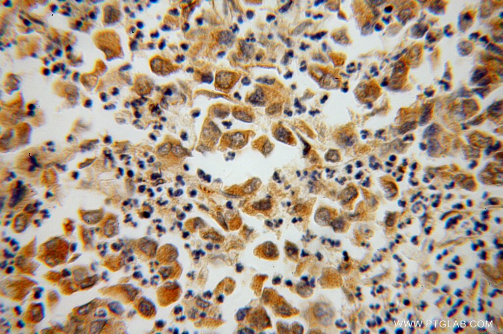 IHC staining of human pancreas cancer using 14231-1-AP