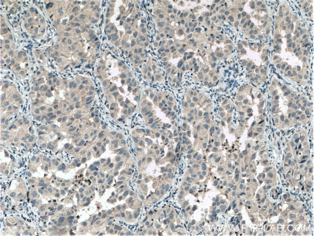 Immunohistochemistry (IHC) staining of human lung cancer tissue using STXBP6 Polyclonal antibody (10976-4-AP)