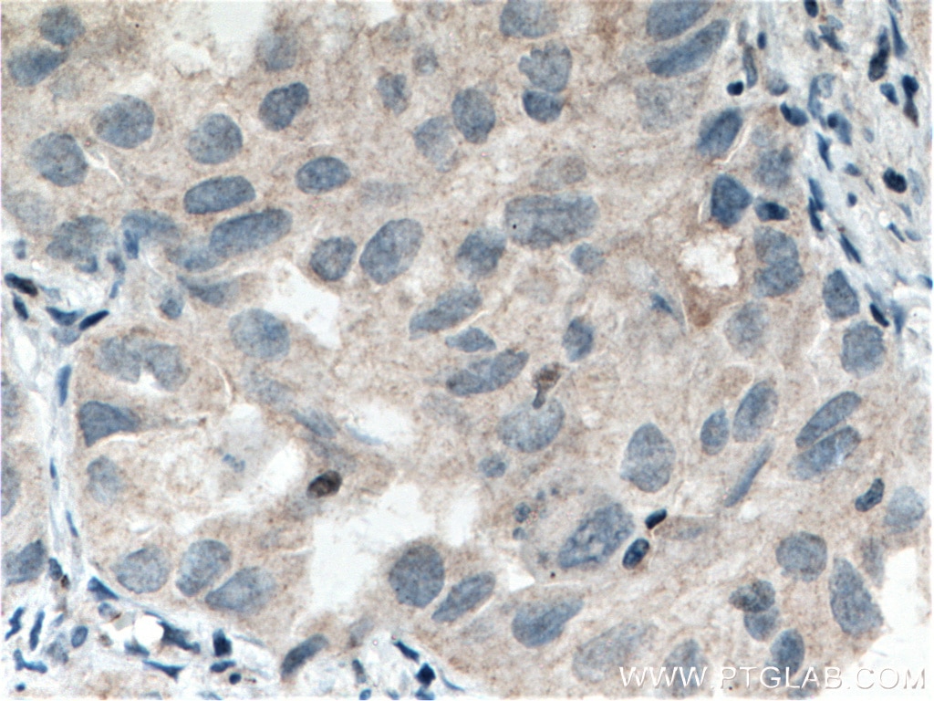 Immunohistochemistry (IHC) staining of human lung cancer tissue using STXBP6 Polyclonal antibody (10976-4-AP)