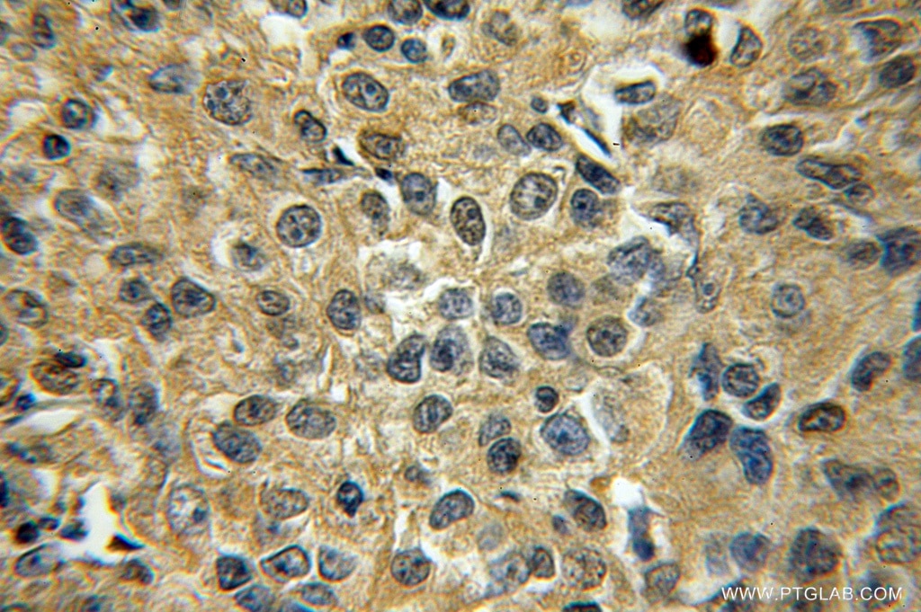 Immunohistochemistry (IHC) staining of human lung cancer tissue using STXBP6 Polyclonal antibody (10976-4-AP)