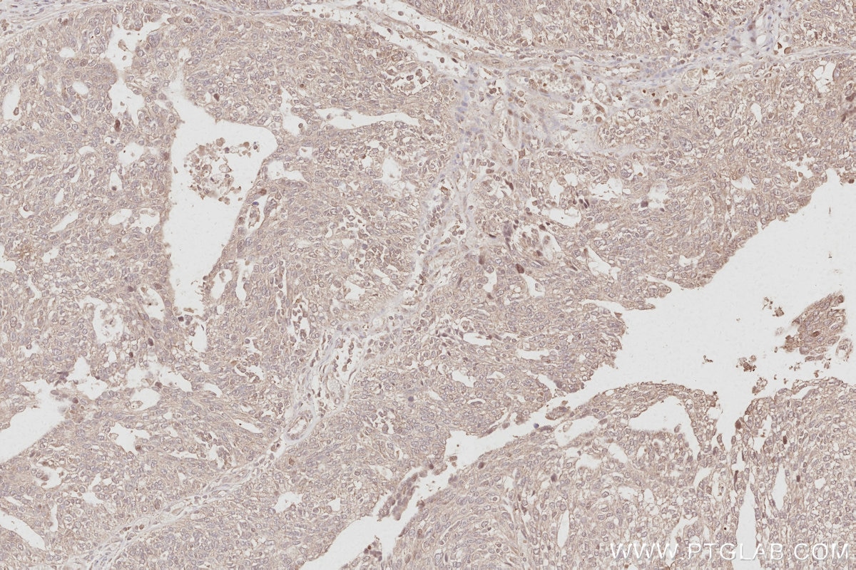 IHC staining of human ovary cancer using 16433-1-AP Immunohistochemistry (IHC) staining of human ovary cancer tissue using STYXL1 Polyclonal antibody (16433-1-AP)