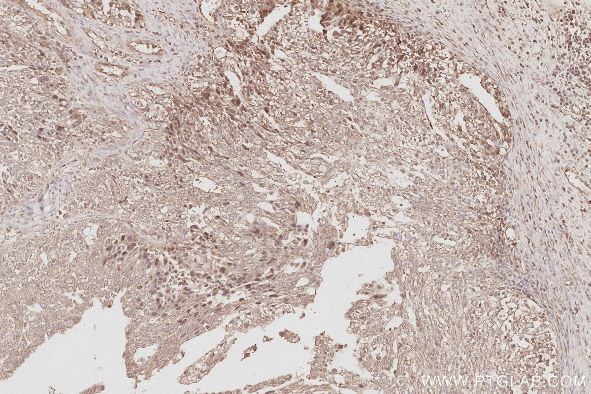 IHC staining of human ovary cancer using 16433-1-AP Immunohistochemistry (IHC) staining of human ovary cancer tissue using STYXL1 Polyclonal antibody (16433-1-AP)