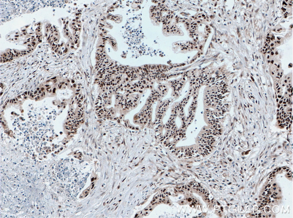 Immunohistochemistry (IHC) staining of human pancreas cancer tissue using SUB1 Polyclonal antibody (10948-2-AP)