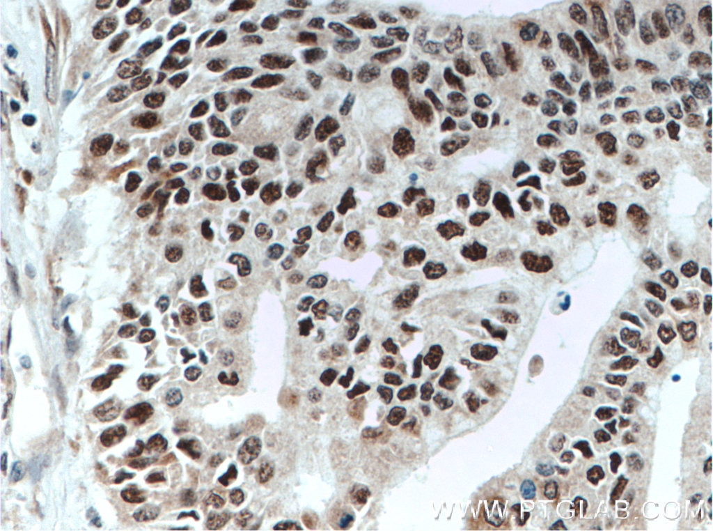 Immunohistochemistry (IHC) staining of human pancreas cancer tissue using SUB1 Polyclonal antibody (10948-2-AP)