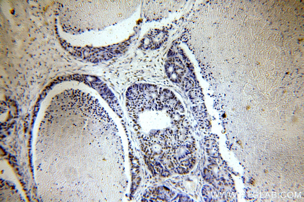 IHC staining of human pancreas cancer using 10948-2-AP