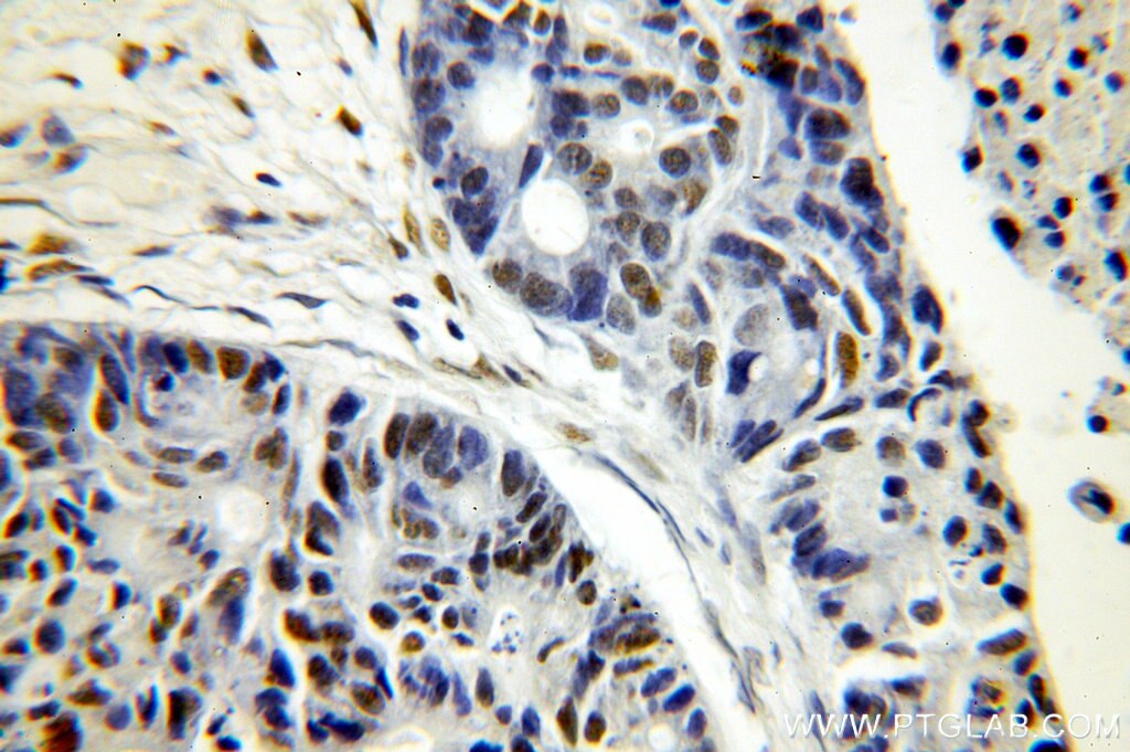 Immunohistochemistry (IHC) staining of human pancreas cancer tissue using SUB1 Polyclonal antibody (10948-2-AP)