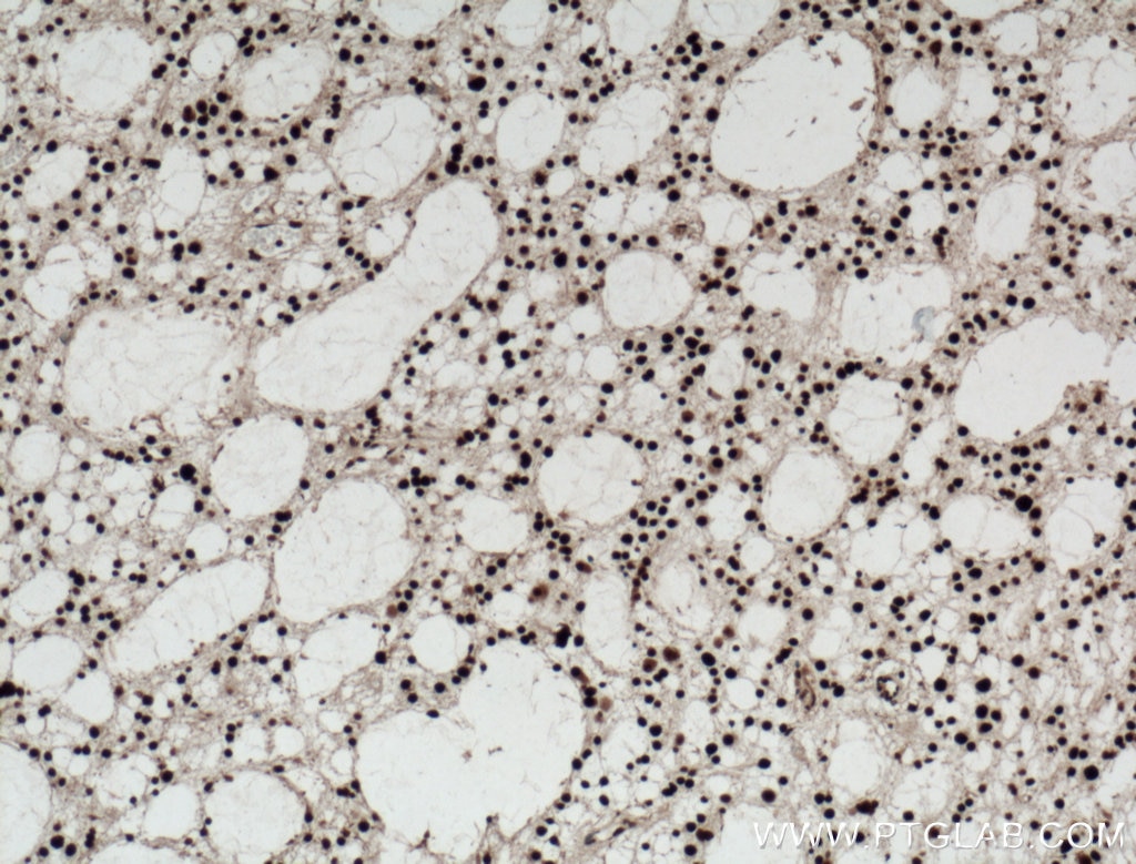 Immunohistochemistry (IHC) staining of human gliomas tissue using SUB1 Polyclonal antibody (11956-1-AP)