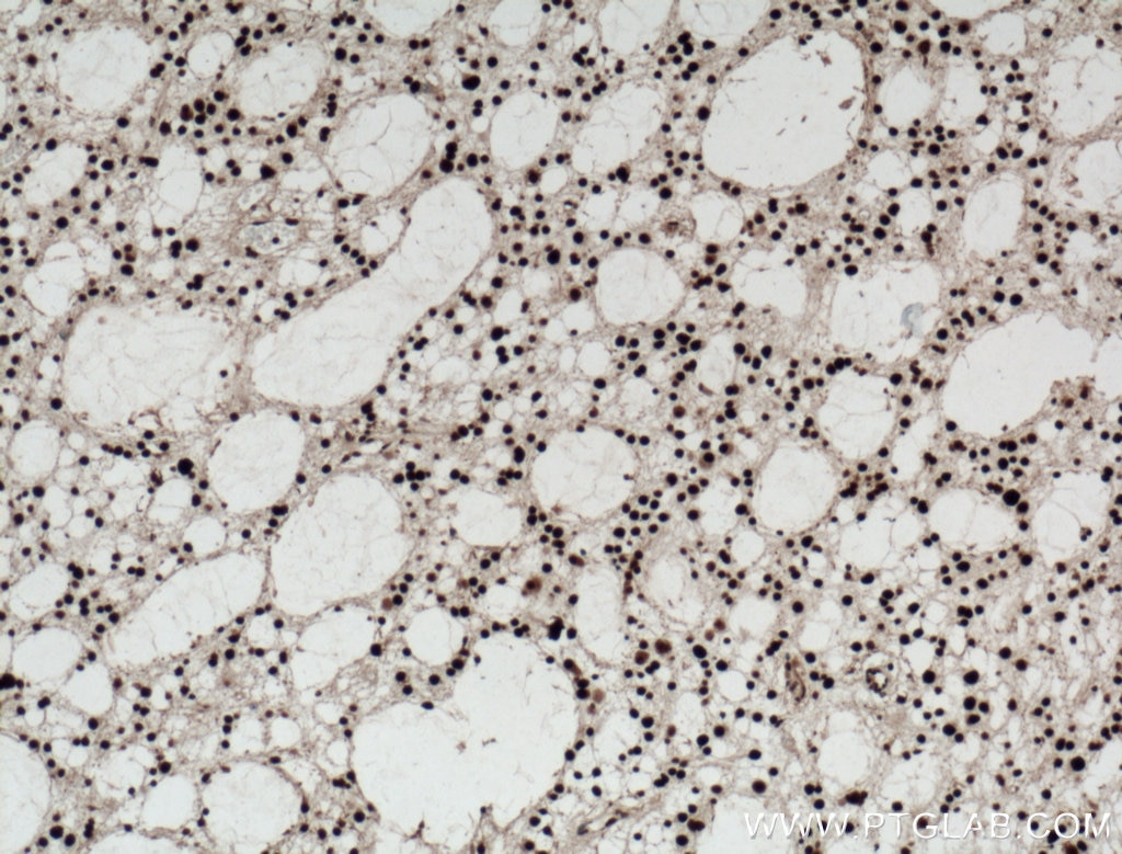 IHC staining of human gliomas using 11956-1-AP