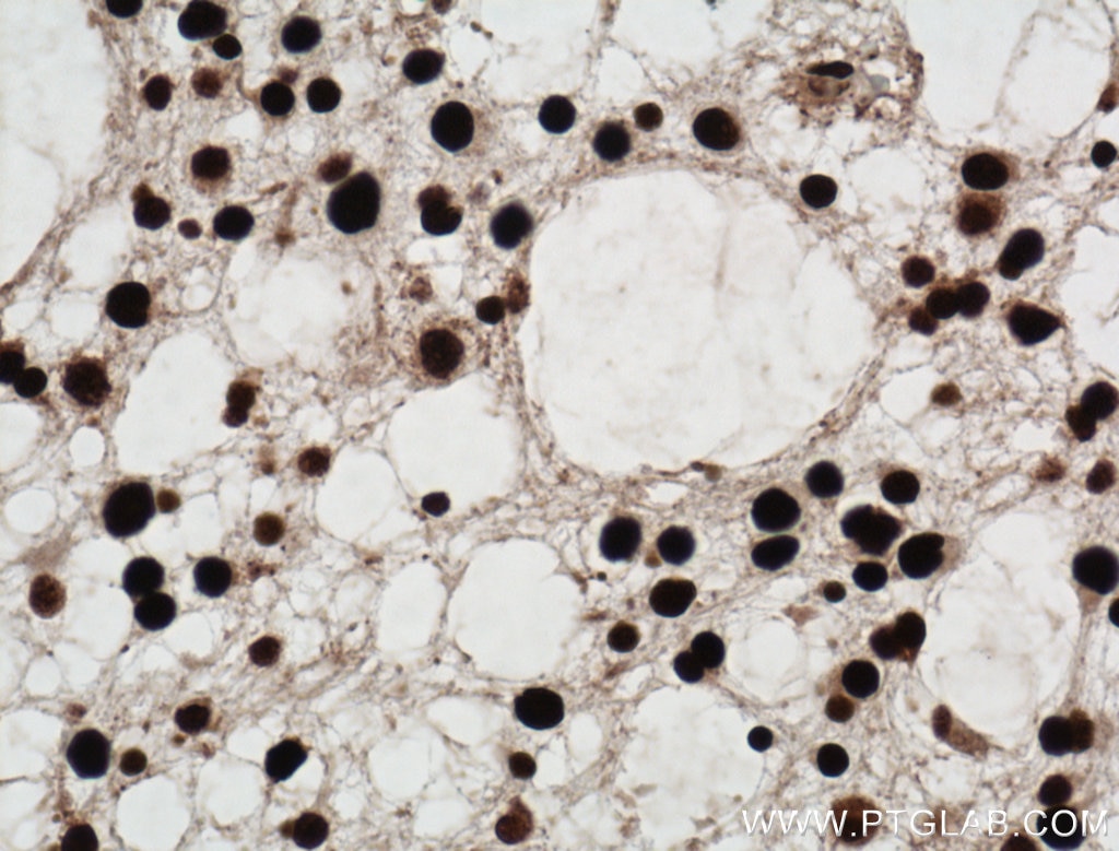 IHC staining of human gliomas using 11956-1-AP