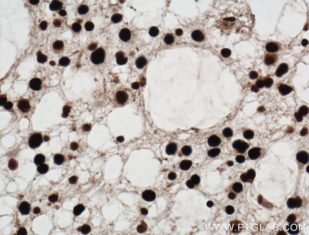 Immunohistochemistry (IHC) staining of human gliomas tissue using SUB1 Polyclonal antibody (11956-1-AP)