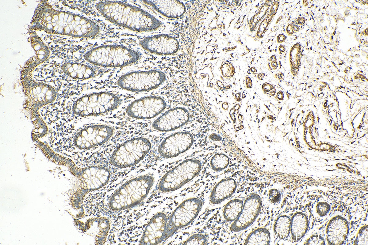 IHC staining of human colon cancer using 12627-1-AP
