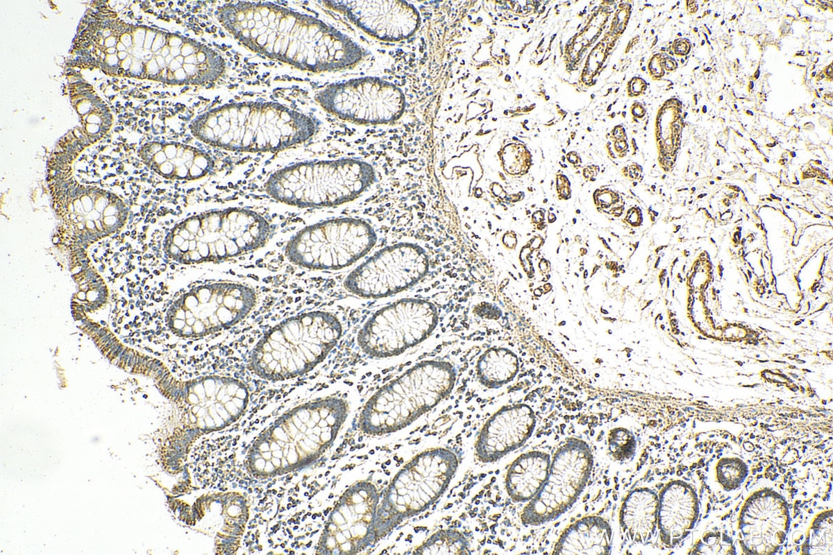 Immunohistochemistry (IHC) staining of human colon cancer tissue using SUCLA2 Polyclonal antibody (12627-1-AP)