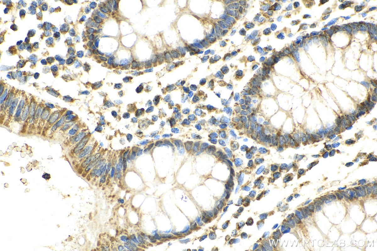 Immunohistochemistry (IHC) staining of human colon cancer tissue using SUCLA2 Polyclonal antibody (12627-1-AP)