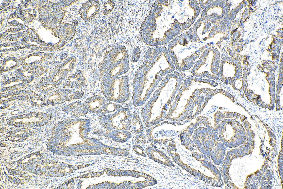 Immunohistochemistry (IHC) staining of human colon cancer tissue using SUCLA2 Polyclonal antibody (12627-1-AP)