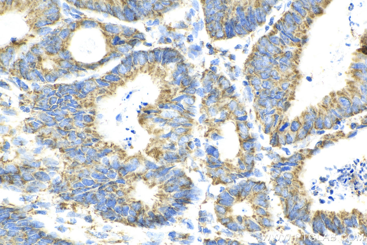 Immunohistochemistry (IHC) staining of human colon cancer tissue using SUCLA2 Polyclonal antibody (12627-1-AP)