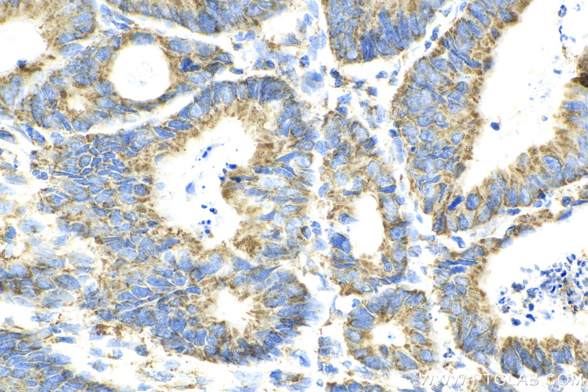 IHC staining of human colon cancer using 12627-1-AP