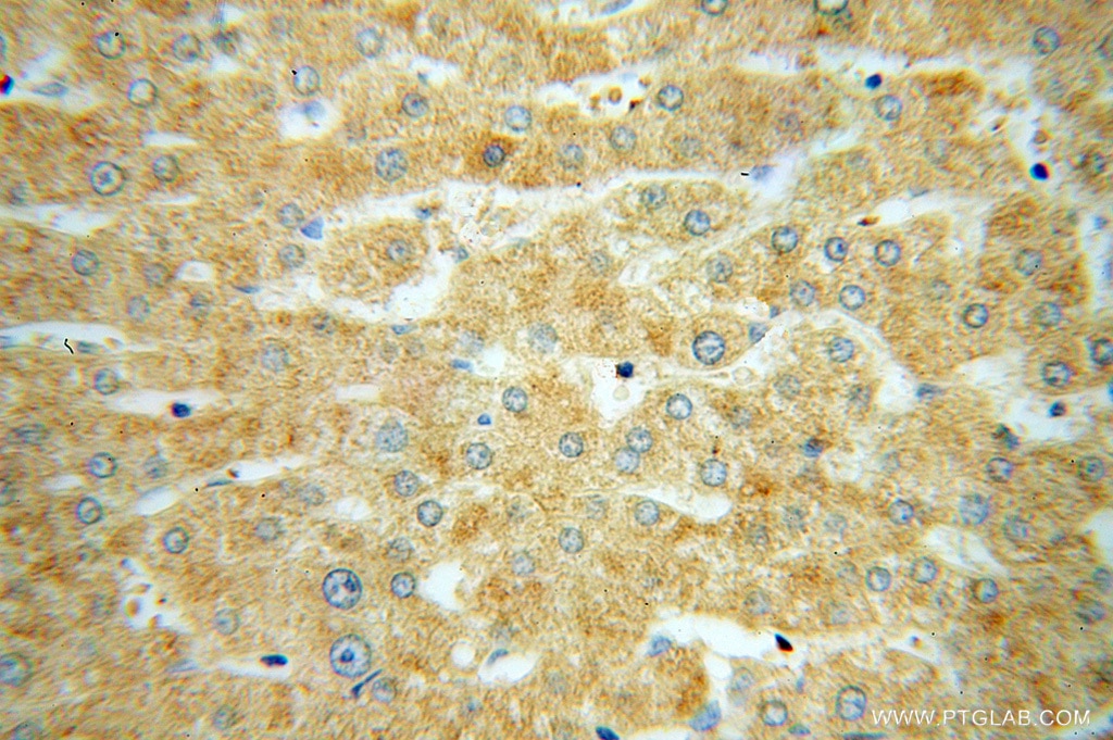 Immunohistochemistry (IHC) staining of human liver cancer tissue using SUCLG1 Polyclonal antibody (14923-1-AP)