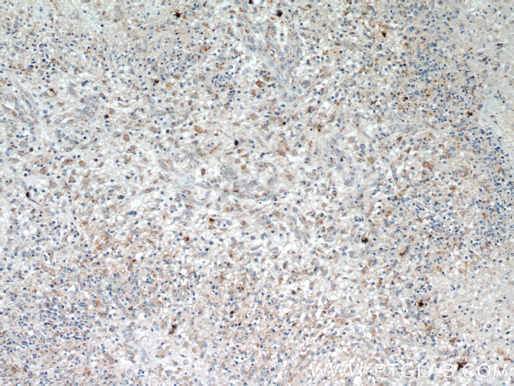 Immunohistochemistry (IHC) staining of human gliomas tissue using SUCLG2 Polyclonal antibody (14240-1-AP)