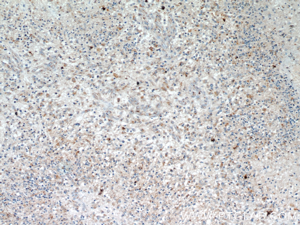 Immunohistochemistry (IHC) staining of human gliomas tissue using SUCLG2 Polyclonal antibody (14240-1-AP)