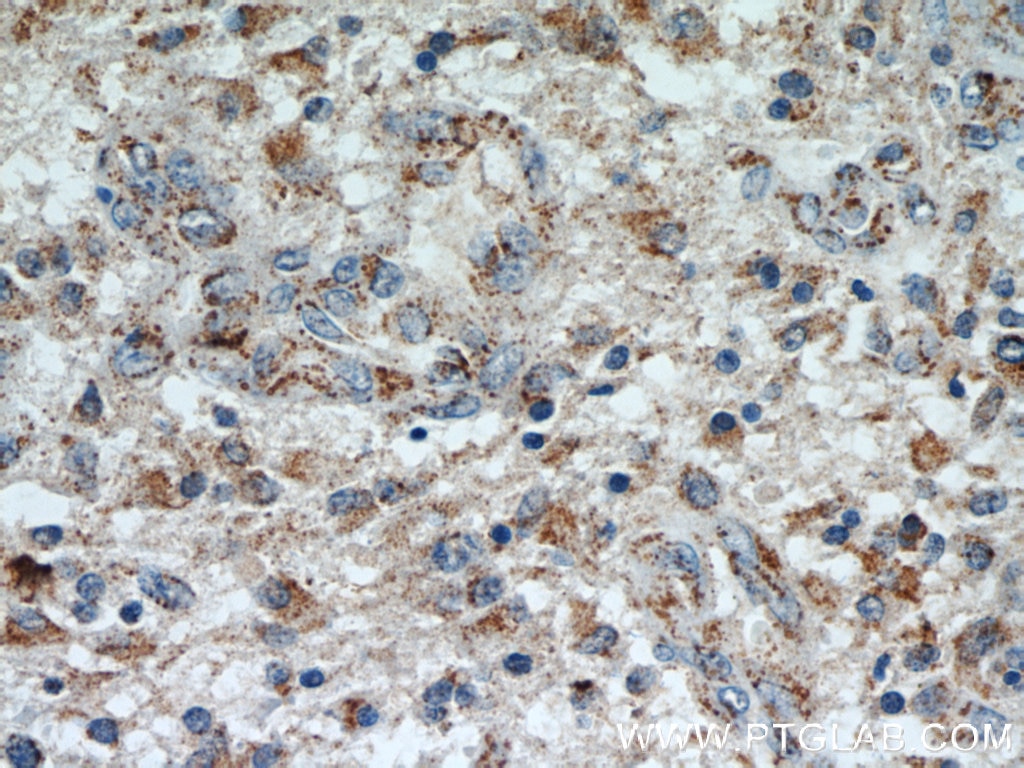 Immunohistochemistry (IHC) staining of human gliomas tissue using SUCLG2 Polyclonal antibody (14240-1-AP)