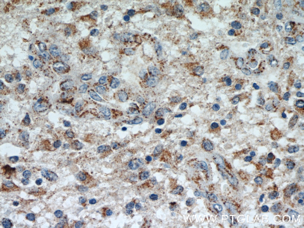 IHC staining of human gliomas using 14240-1-AP