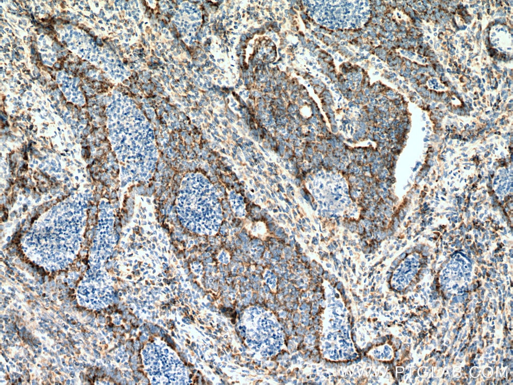 Immunohistochemistry (IHC) staining of human colon cancer tissue using SUCLG2 Polyclonal antibody (14240-1-AP)