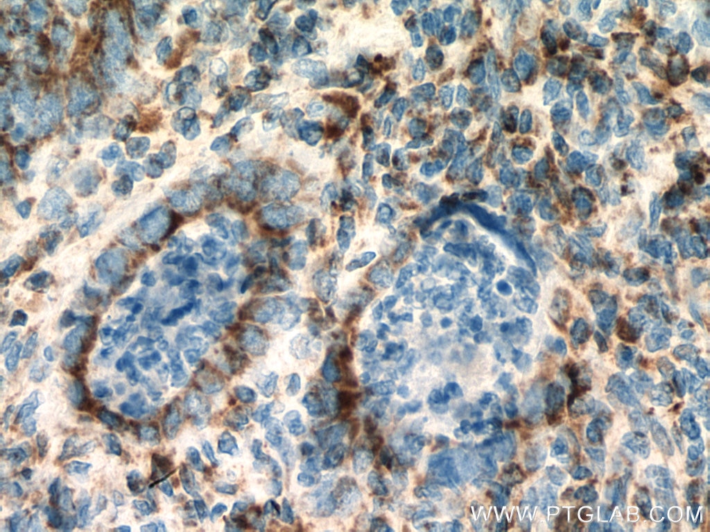 IHC staining of human colon cancer using 14240-1-AP