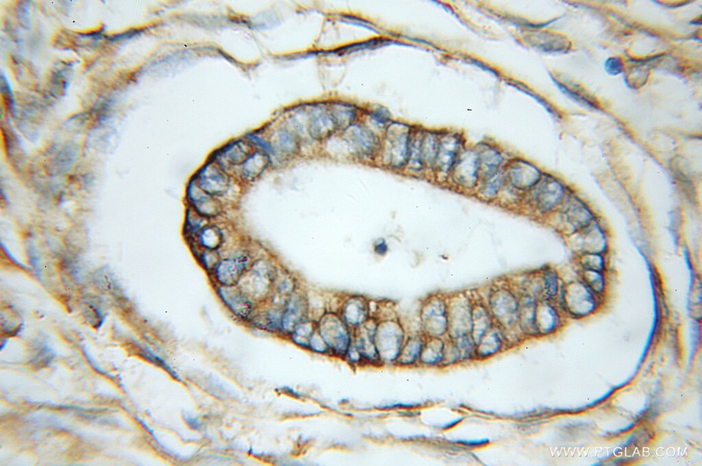 Immunohistochemistry (IHC) staining of human pancreas cancer tissue using SUGT1 Polyclonal antibody (11675-1-AP)