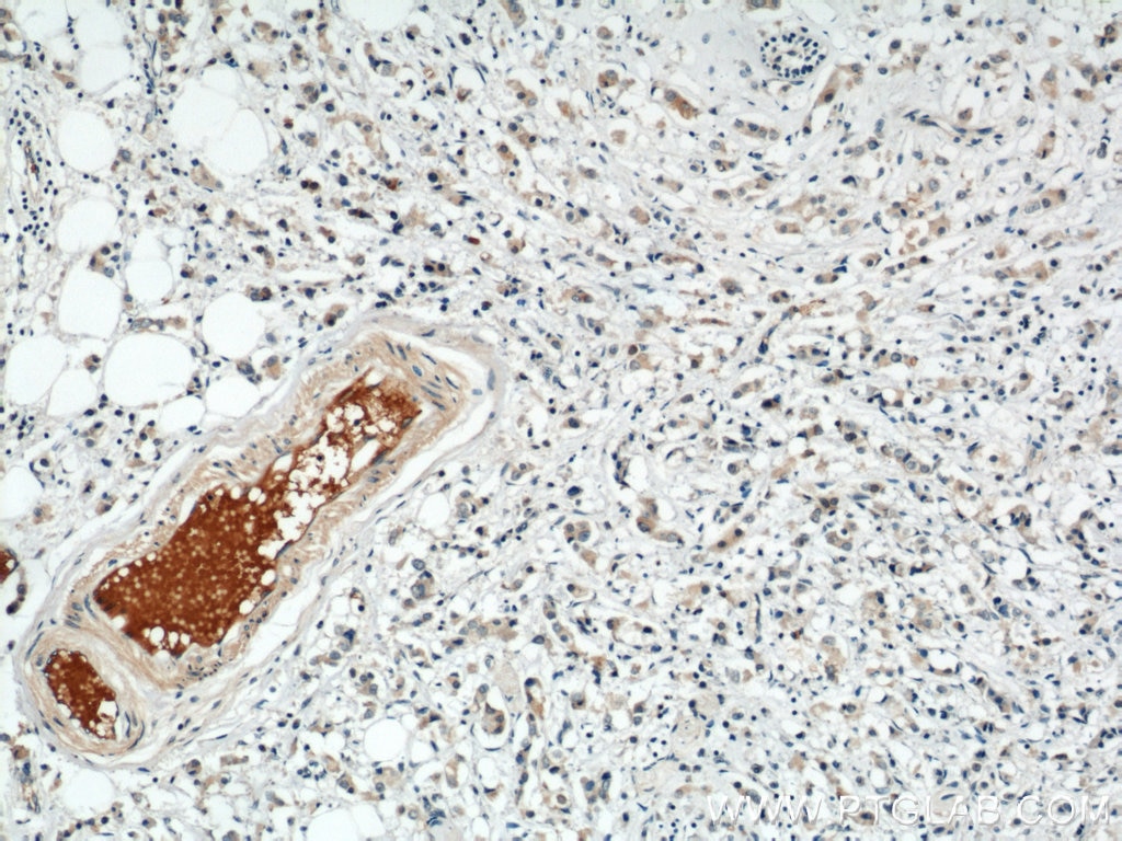 IHC staining of human breast cancer using 12260-1-AP