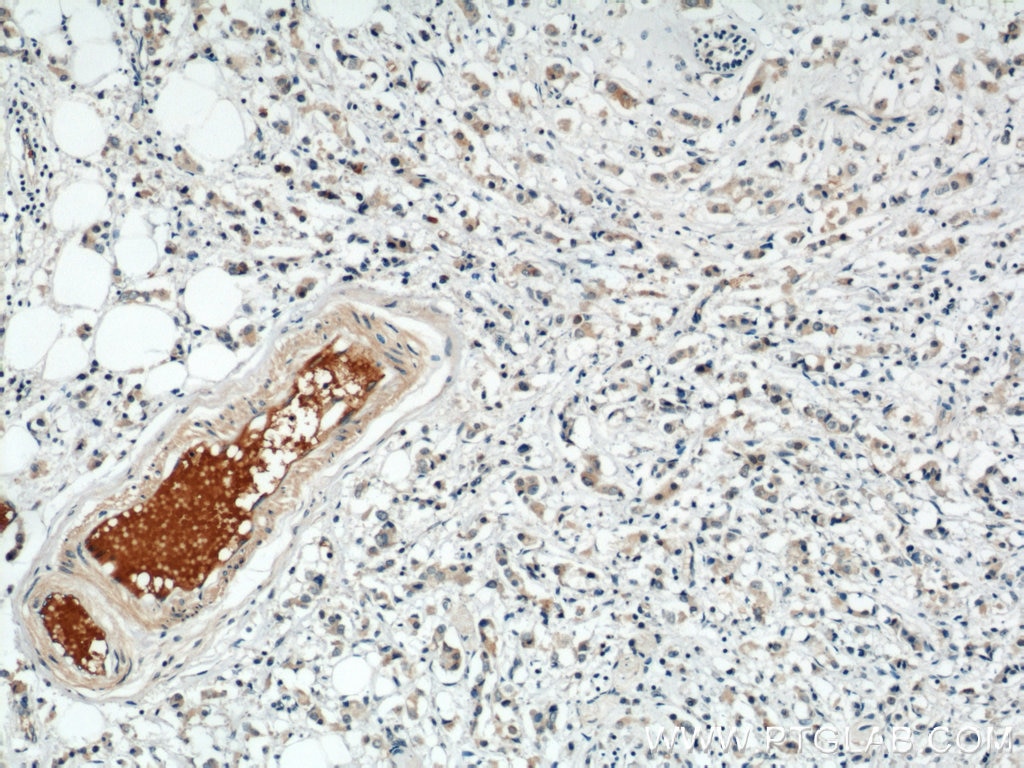 Immunohistochemistry (IHC) staining of human breast cancer tissue using SULF2 Polyclonal antibody (12260-1-AP)