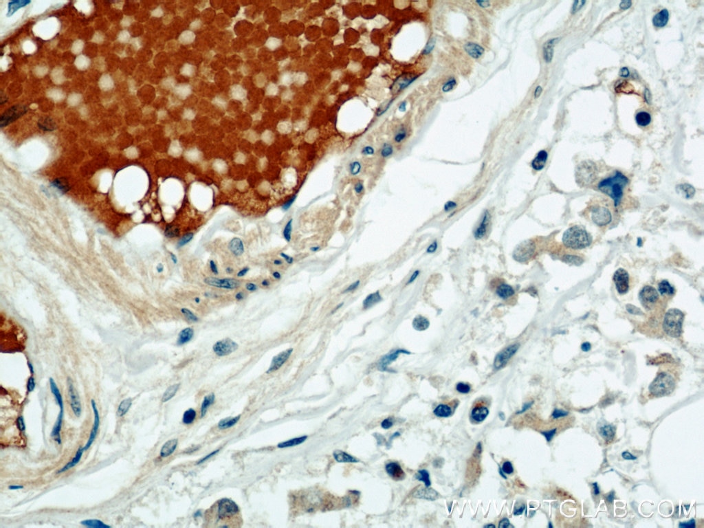 Immunohistochemistry (IHC) staining of human breast cancer tissue using SULF2 Polyclonal antibody (12260-1-AP)