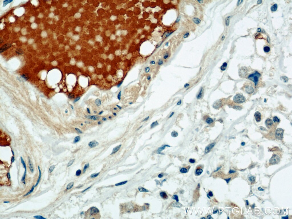 Immunohistochemistry (IHC) staining of human breast cancer tissue using SULF2 Polyclonal antibody (12260-1-AP)