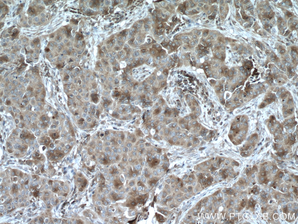 Immunohistochemistry (IHC) staining of human breast cancer tissue using SULT1A3 Polyclonal antibody (19499-1-AP)