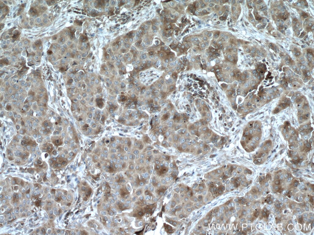 IHC staining of human breast cancer using 19499-1-AP