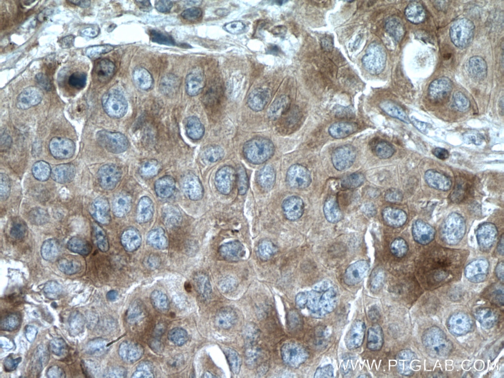 Immunohistochemistry (IHC) staining of human breast cancer tissue using SULT1A3 Polyclonal antibody (19499-1-AP)