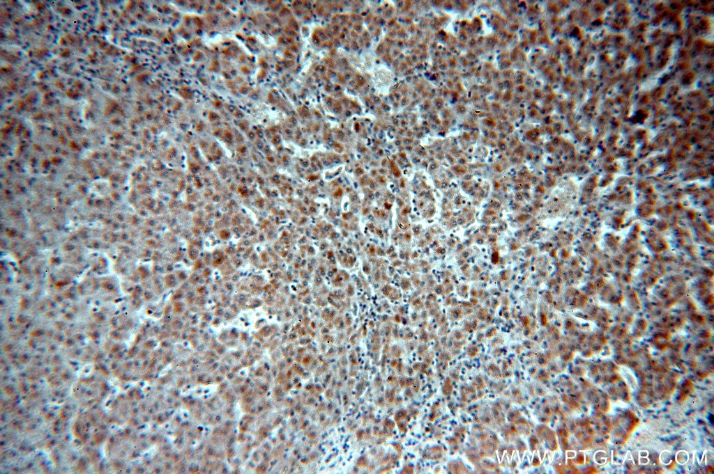 Immunohistochemistry (IHC) staining of human hepatocirrhosis tissue using SULT1A3 Polyclonal antibody (19499-1-AP)