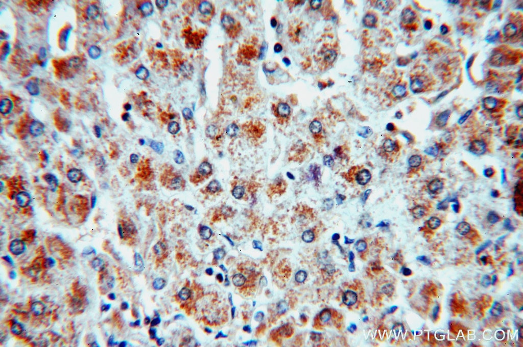 Immunohistochemistry (IHC) staining of human hepatocirrhosis tissue using SULT1A3 Polyclonal antibody (19499-1-AP)