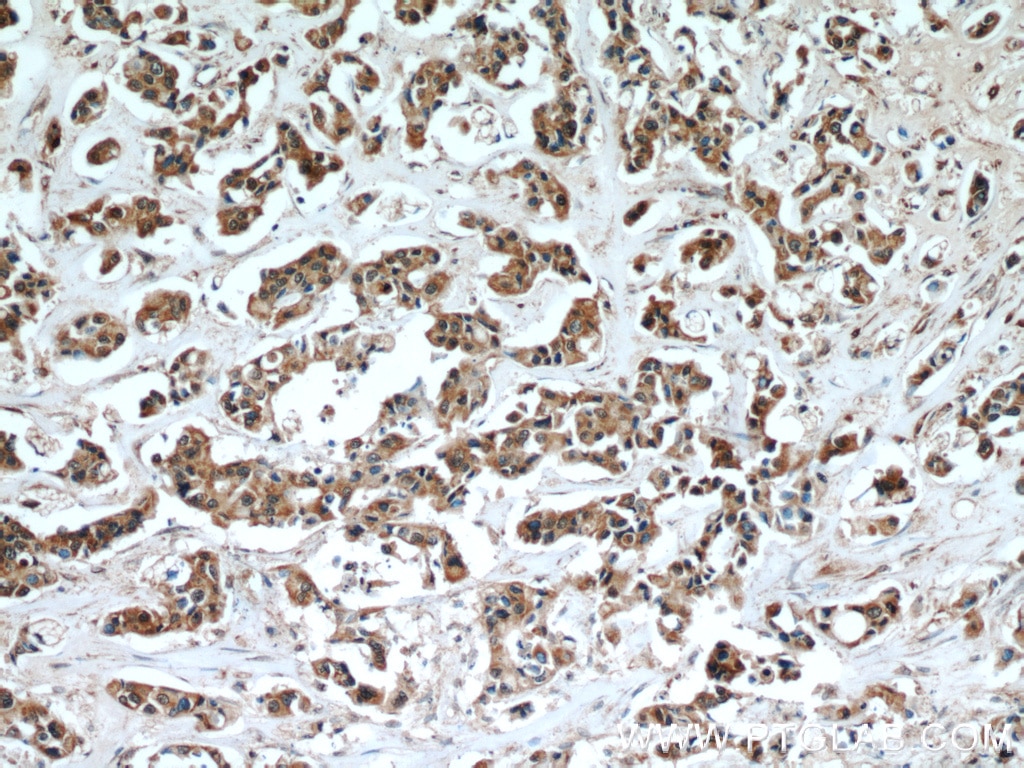 IHC staining of human breast cancer using 19499-1-AP